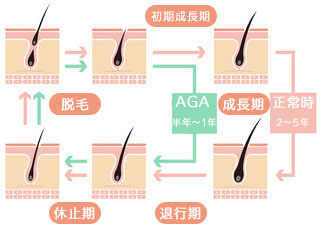 AGAのヘアサイクル