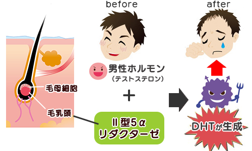 AGAでハゲる仕組み